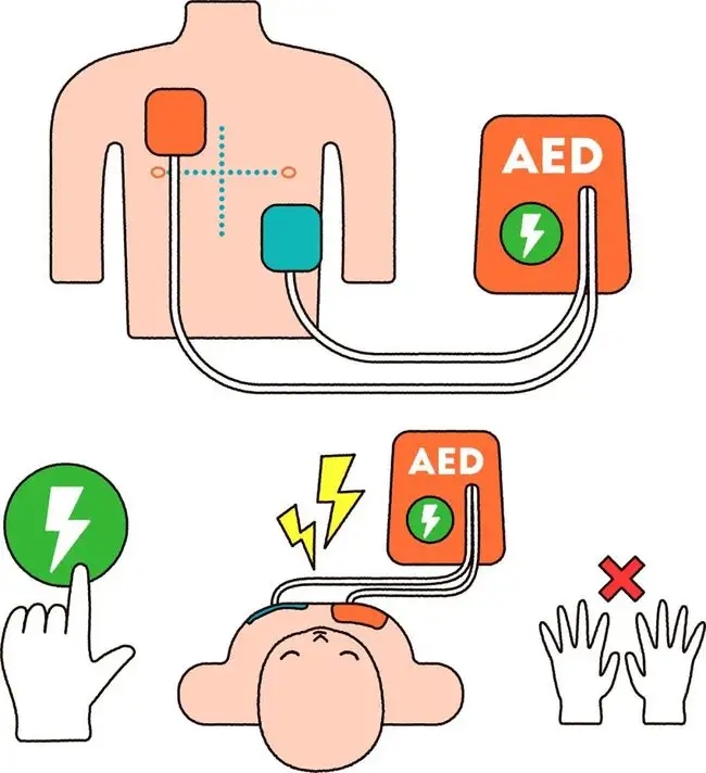 第三类医疗器械：救命神器AED，把握黄金四分钟