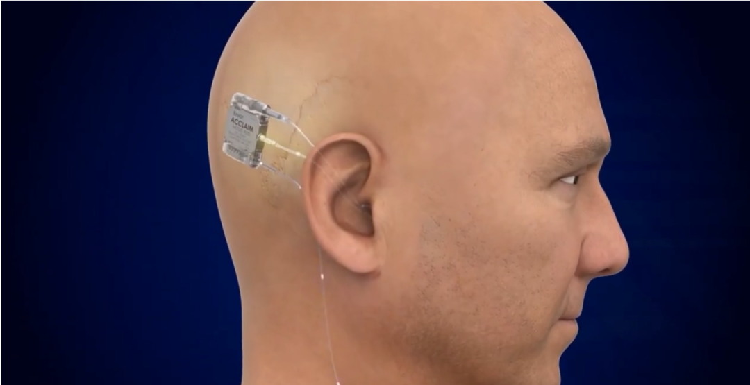 颠覆性设计！全球唯一完全植入式人工耳蜗通过FDA进入可行性研究